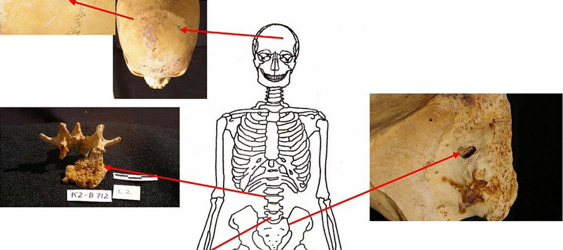 Illustration for article titled Huesos egipcios de hace 3.000 años revelan una verdad incómoda: el cáncer es hasta 100 veces más común hoy